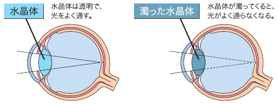 白内障とはどんな病気？
