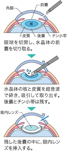 白内障手術