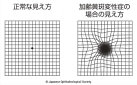 (1)アムスラー検査