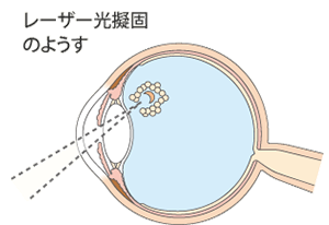 網膜裂孔の進行を抑えます