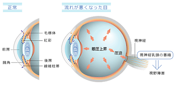 SLT(選択的レーザー線維柱帯形成術)とは